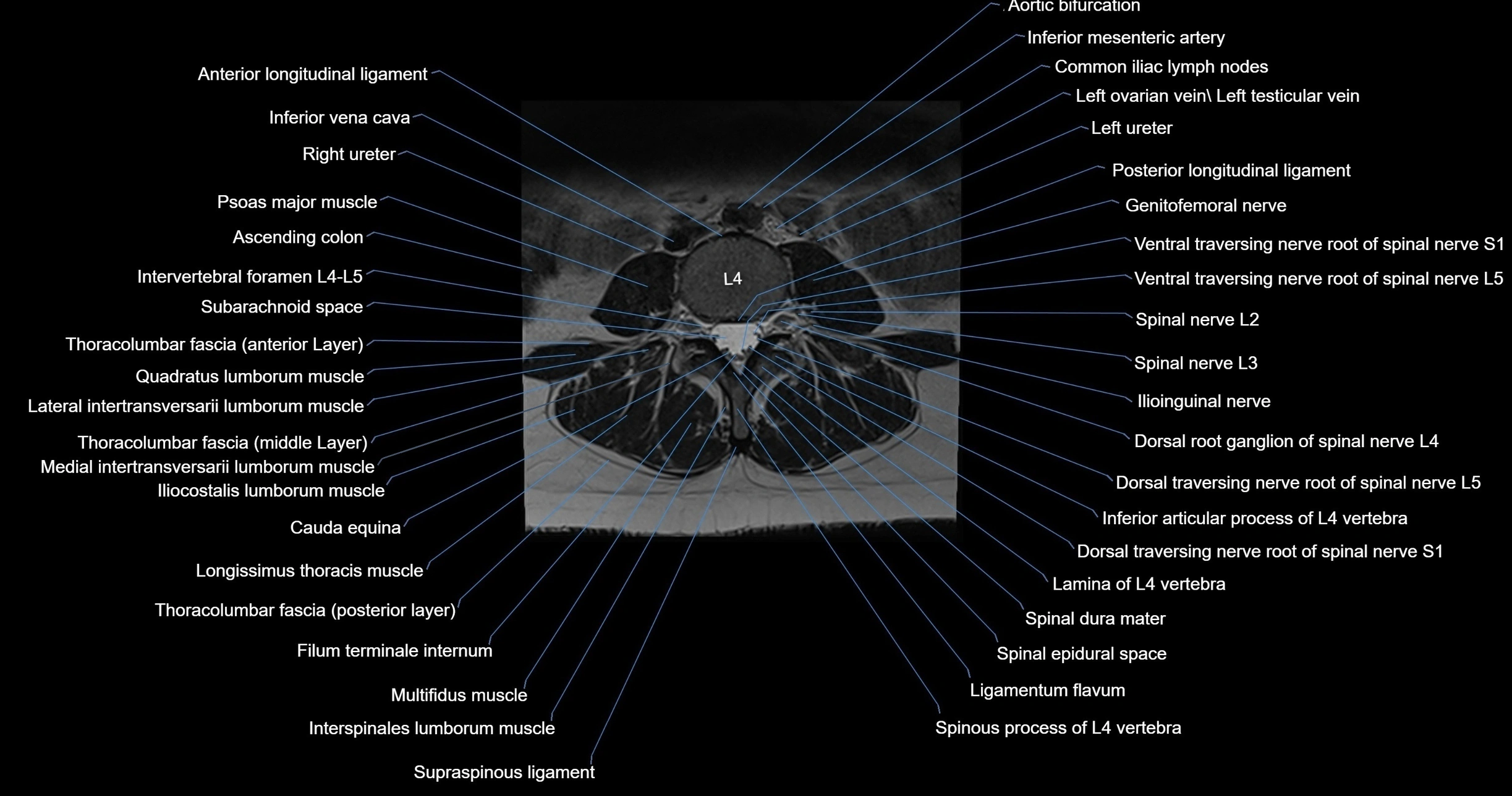 MRI lumbar spine axial cross sectional anatomy 3T radiology  image-img-00001-00032.webp